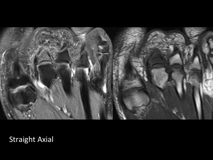 Figure 3 for case plantar plate of metatarsophalangeal joint ( RID3134 )